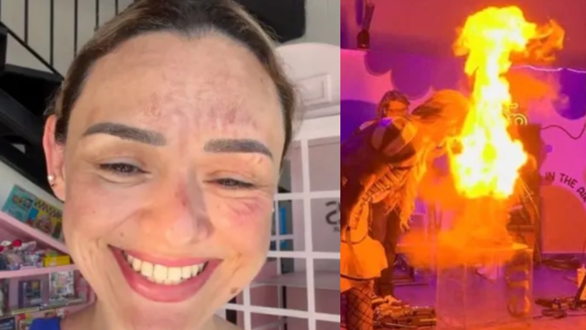 Arlen Hernández: Influencer Sufre Quemadura Facial por un ‘Pastel Explosivo’